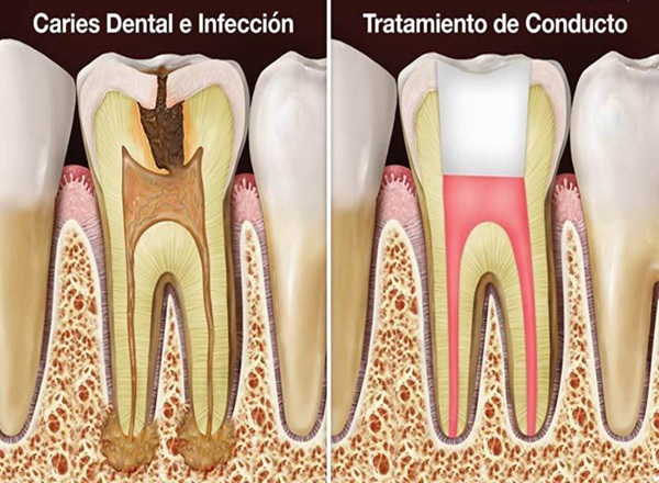 tratamiento antes y después de una endodoncia